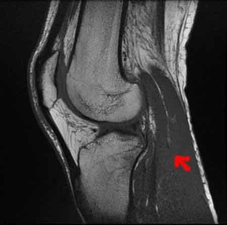 JAMBE EN MOUSSE DANS LE TEAM JACKY SHOW (from cotton)