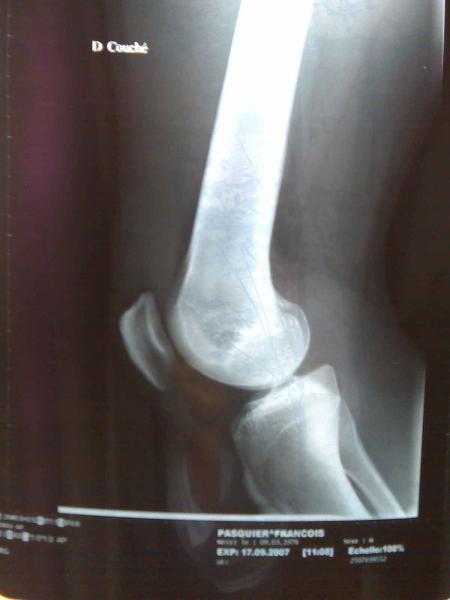 JAMBE EN MOUSSE....PREMIER BILAN!!!!!